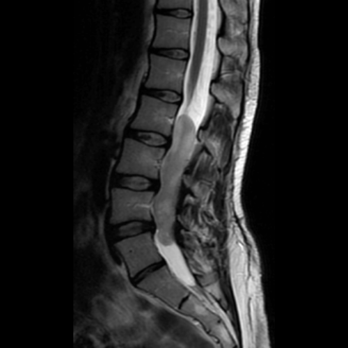 Omurilik Tümörleri