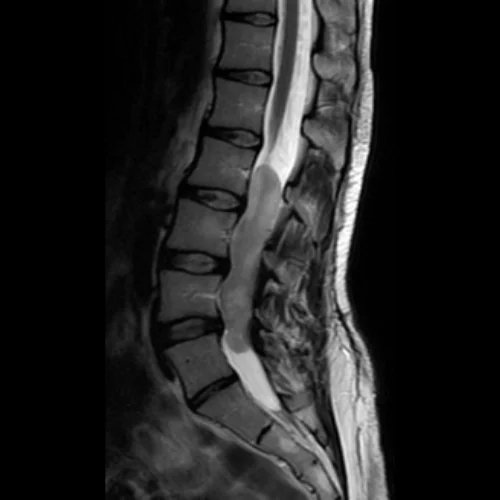 Spinal Cord Tumors