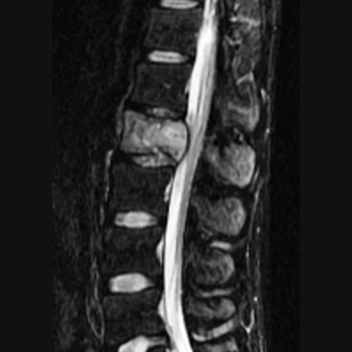 Spinal Tumors