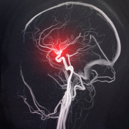 Beyin Anevrizma Kanamaları 