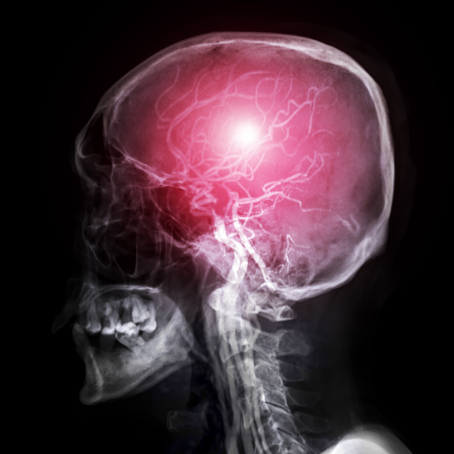 Beyin Damar Hastalıkları