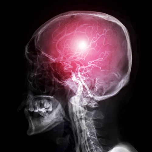 Vascular Diseases of Brain