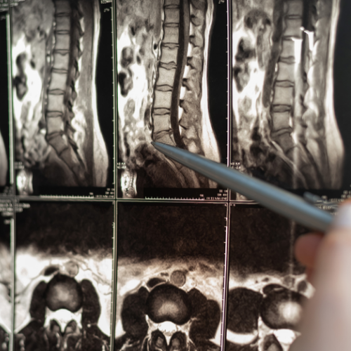 Doğumsal Omurga ve Omurilik Hastalıkları