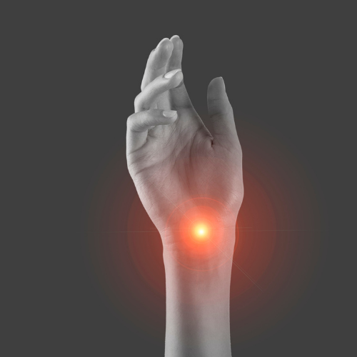 Karpal Tünel Sendromu